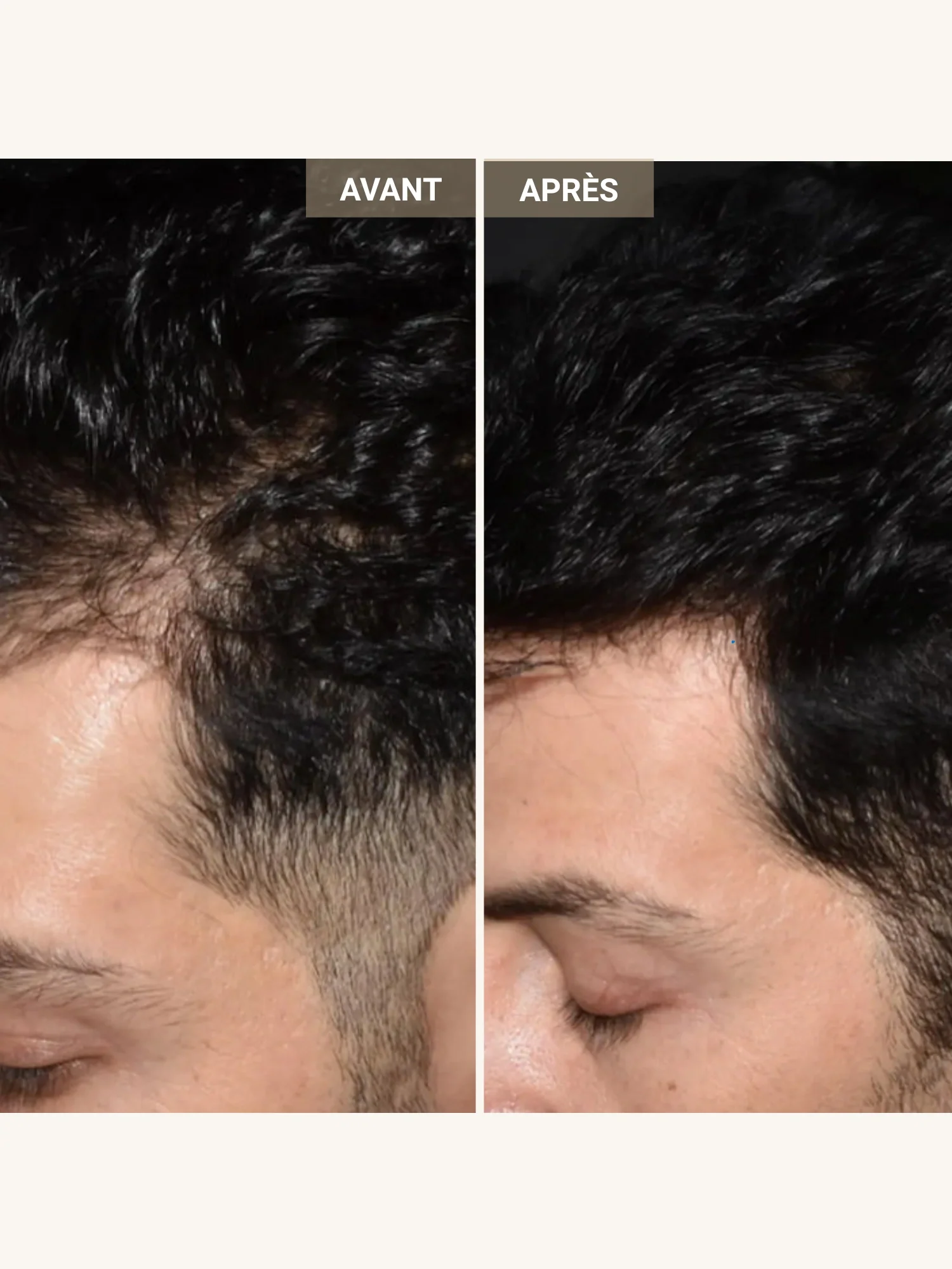 Casque LED & laser cheveux "Le Professionnel" - Image 5